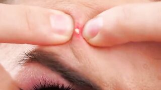DON'T TOUCH MY PIMPLES!