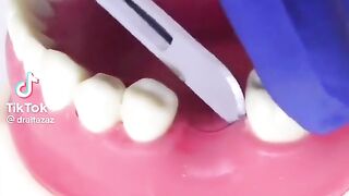 Dentak implant