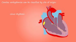 Cardiac arrhythmias