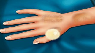 [ASMR] Burn Skin Treatment