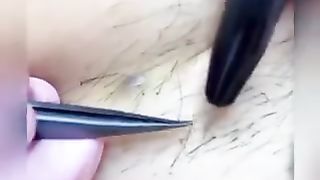 Hair remov style