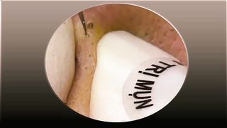 Acne Removal - Black heads Removal