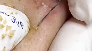 Acne Removal - Blackheads Episode 2
