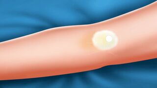{ASMR} Colorectal Cancer Surgery Animation