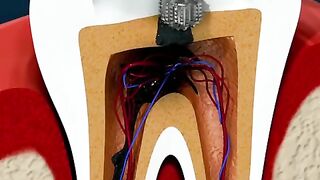Root Canal Treatment  Tooth Abscess