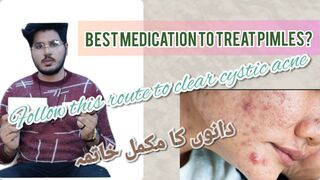 Cystic acne best treatmentI|| pimples ka best ilaj