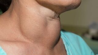Best Foods to Fight Thyroid Problem