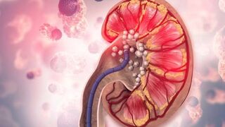 Early Sign of Kidney Disease