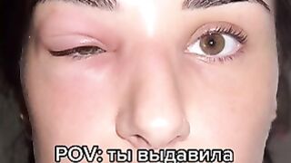 Не выдавливайте прыщи