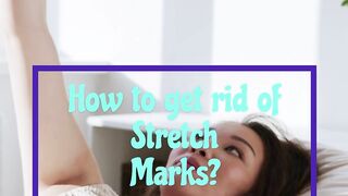 How to get rid of stretch marks