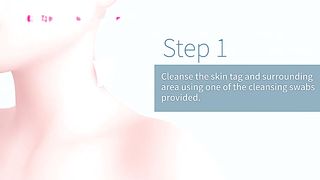 Skin Tag Removal Kit Home Use Mole Wart Remover Micro Band Skin Tag Treatment Tool Easy To Clean Skin Care Tool