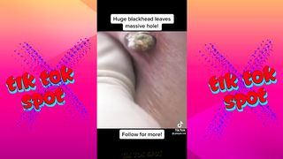 Blackhead Removal Pimple Popping TikTok Compilation