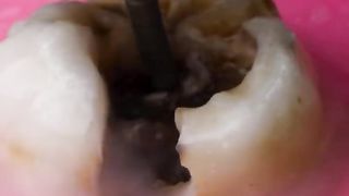 Removing Tooth Decay