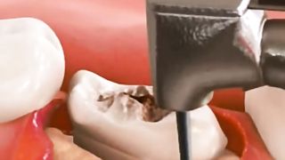 Surgical Extraction and Bone Graft
