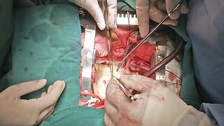 Human Open Heart surgery in HD