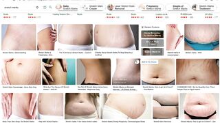 best treatment options for stretch marks