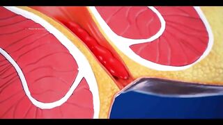 How to cause Piles Haemorrhoide