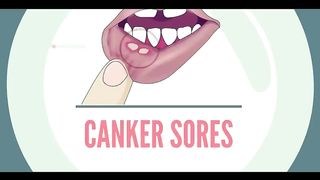 Why_Do_We_Get_Canker_Sores____Symptoms%2C_Causes_and_treatment__Urdu_Hindi_(720p).