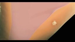 How_Uterine_Fibroids_Grow_In_Uterus___Urdu_Hindi_(720p).