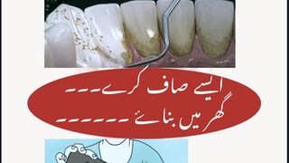 The #1 Top Remedy for Dental Plaque at Home!پیلے دانت گھر میں کرے سفید