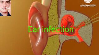 Ear infection