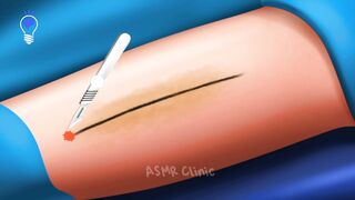 Fractured Leg Bone Surgery Animation