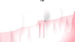 tooth implant medical