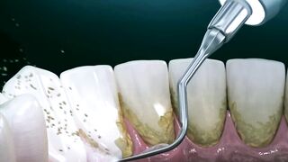 Remedy for Dental Plaque (