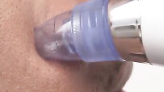 blackhead vacuum remover