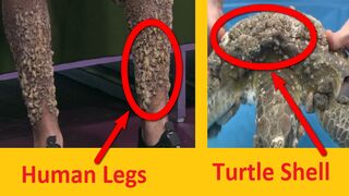 Turtle parasites have stuck to the feet of a person