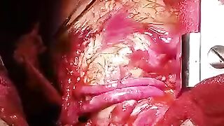 Treatment of heart