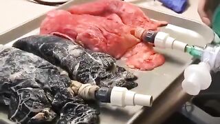 Healthy lungs vs smokers lungs ????
