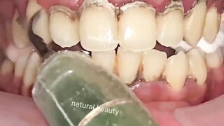 Teeth whitening and scaling at home in 1 minute