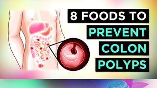 Foods that prevent Colon Polyps
