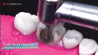 Teeth treatment