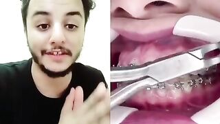خلع تقويم الاسنان