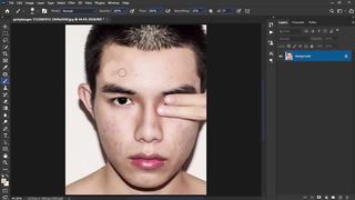 Fastest way to clean your face in photoshop Remove pimples blemishes acne easily