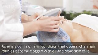How to prevent acne