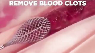 BLOOD CLOT