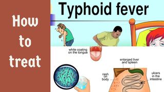 Typhoid Fever treatment