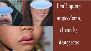 How to treat angioedema