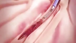 Blood clots removal