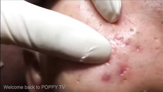 Deep Blackheads Removal from Cheeks and Nose Best Pimple Popping Videos