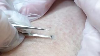 Most Extreme Beauty Treatments