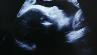 ultrasound waves