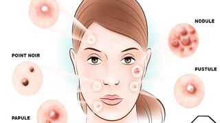 SOLUTION POUR L'ACNE