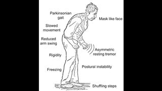 Parkinson's disease symptoms, diagnosis & treatment