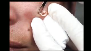 Medical sciences / Blackheads lovers