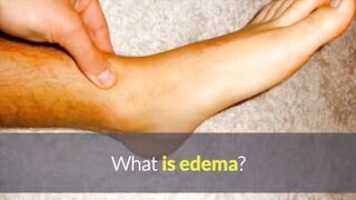Edema symptoms, causes, diagnosis & treatment
