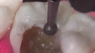 How to remove caries. Как удаляют кариес